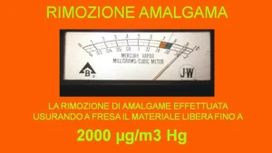 Scopri di più sull'articolo Rimozione Amalgama (RA)