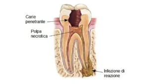 Scopri di più sull'articolo Perchè si Devitalizza (DE)