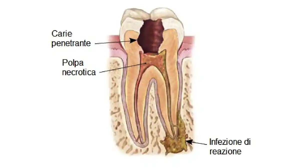 Scopri di più sull'articolo Perchè si Devitalizza (DE)