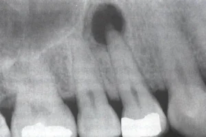 Scopri di più sull'articolo Dente Sano e Malato (DE)