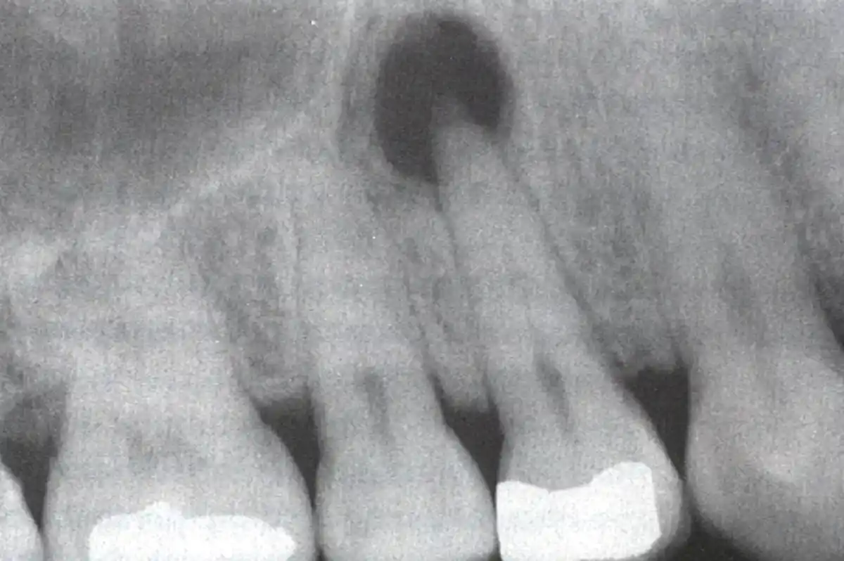 Scopri di più sull'articolo Dente Sano e Malato (DE)